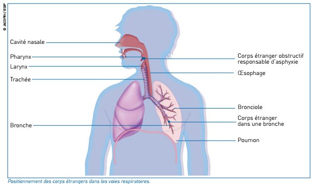 Positionnement des corps étrangers dans les voies respiratoires.